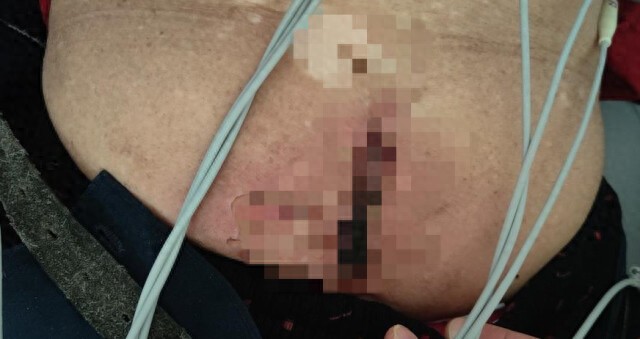 贴身使用暖宝宝,八旬老人皮肤二度烫伤