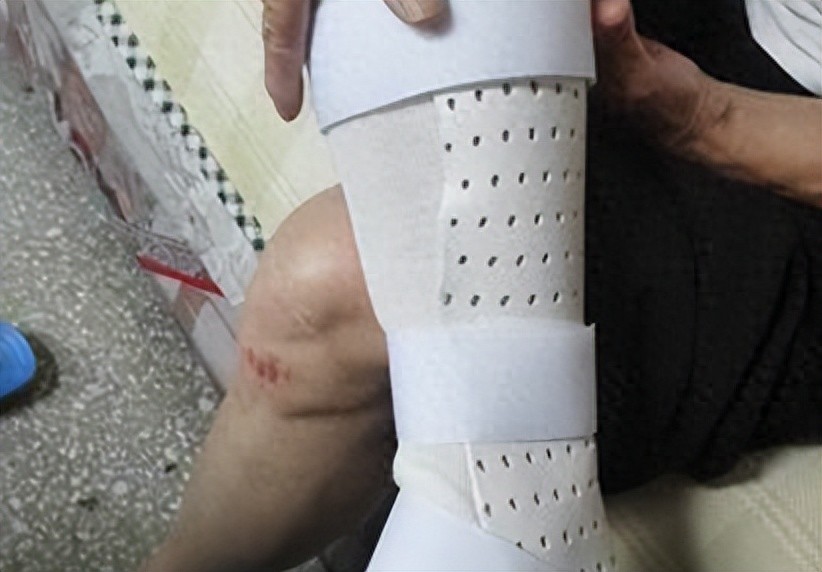 骨折就转运?骨折后多久能康复?骨科医生帮您解答