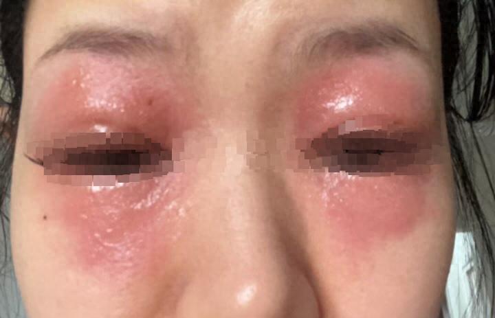 女子种睫毛后双眼红肿自称一个月前得过荨麻疹医生:过敏体质