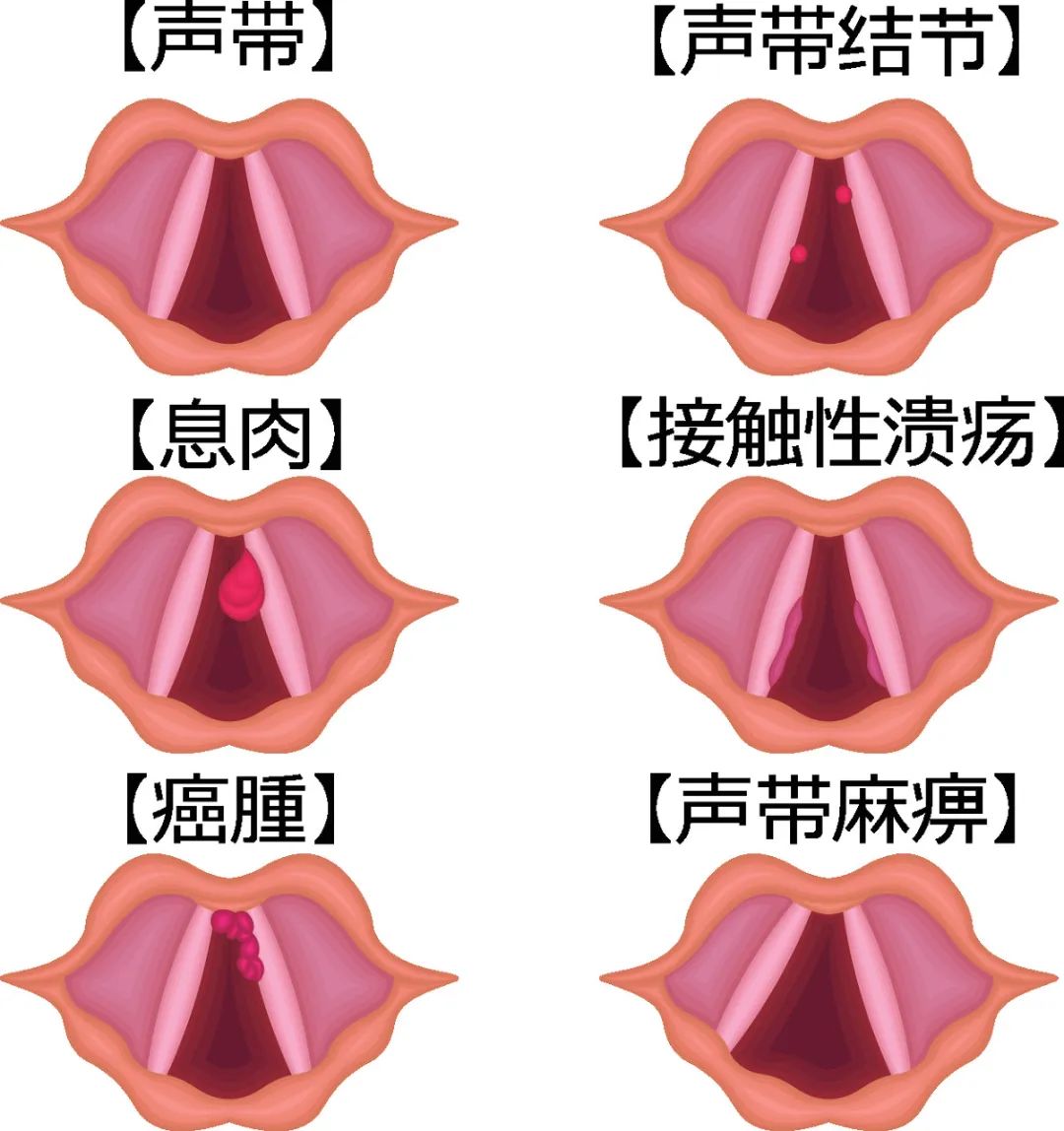 这些位置长了息肉,一定要当心!尤其这种几乎100%会癌变今日