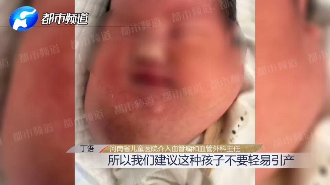 胎儿下颌长15cm巨物,比头还大!妈妈不忍引产,医生成功逆转生