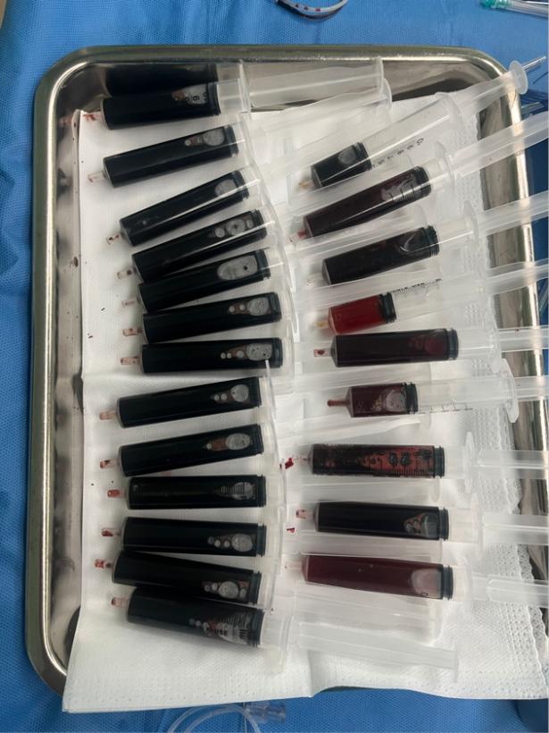 胎儿下颌长15cm巨物,比头还大!妈妈不忍引产,医生成功逆转生
