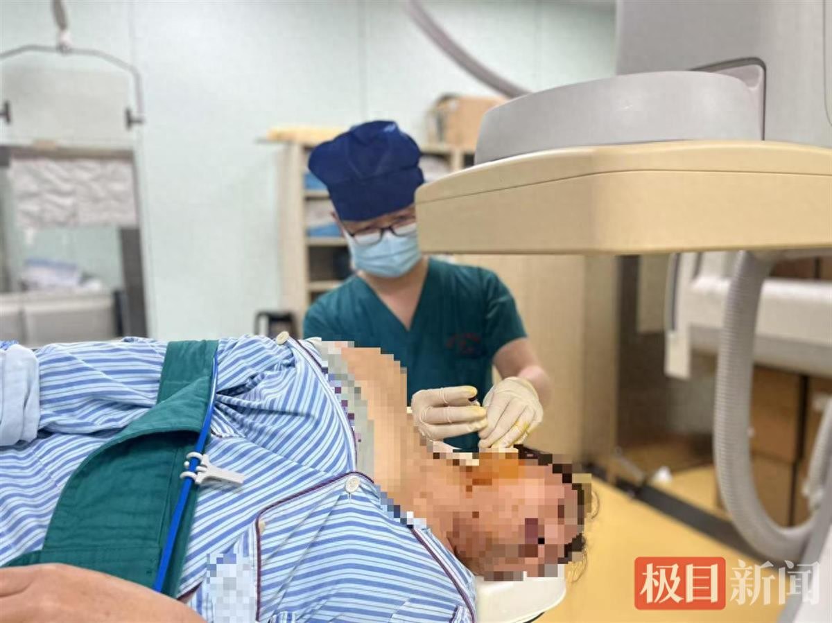 频繁闭眼原是患上梅杰综合征，微创射频治疗助女子重获清晰视界